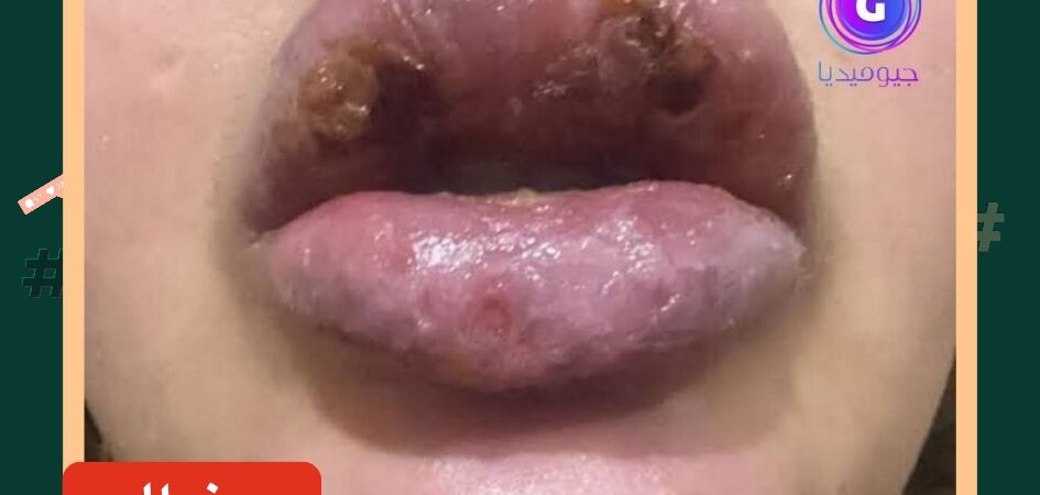 الصورة ليست لسيدة ليبية بل لشابة أردنية ضحية فيلر