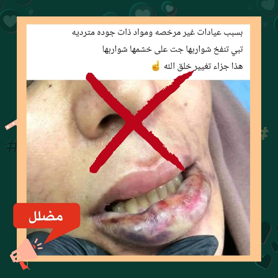 ادعاء تشوّه سيدة ليبية بعد حقن تجميلي في عيادة غير مرخّصة